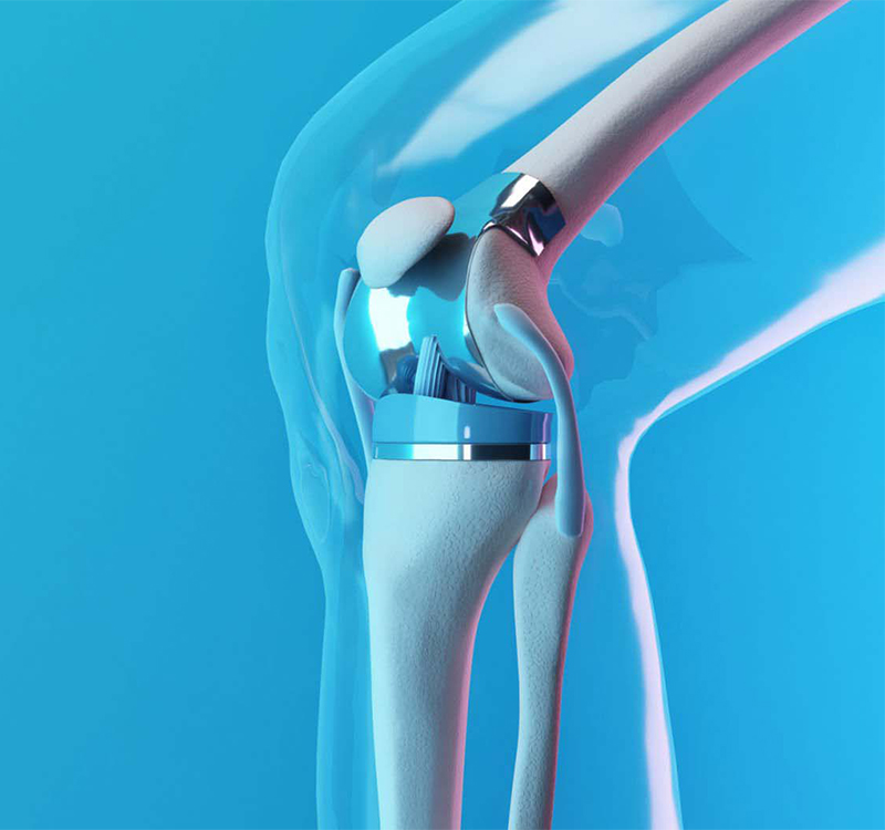 Knee replacement 